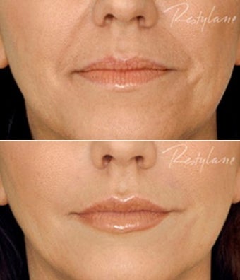 Restylane Lips Wrinkles Before After before 6284