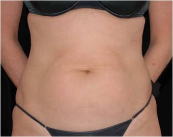 SlimLipo Abdomen Showing Skin Tightening before 97356