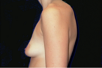 breast augmentation with lift before 630075