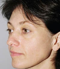 blepharoplasty (eyelids) before 219358
