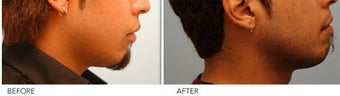 Upper and Lower Lip Reduction 333433
