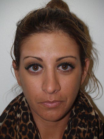 Revision Rhinoplasty before 528759