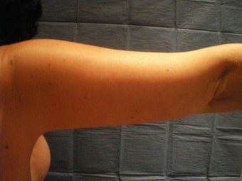 Arm Lift after 155761