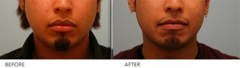 Upper and Lower Lip Reduction before 333433