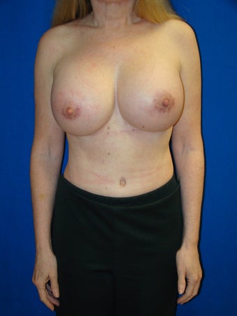 Breast Augmentation Revision after 79499