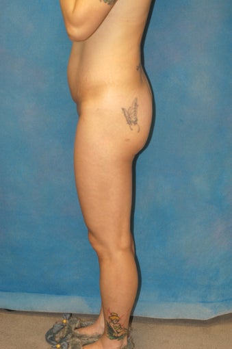Women's Buttocks Augmentation before 518133