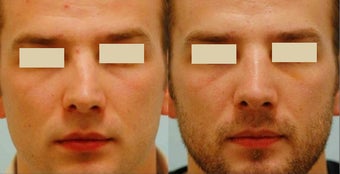 Revision/Corrective Rhinoplasty before 136562