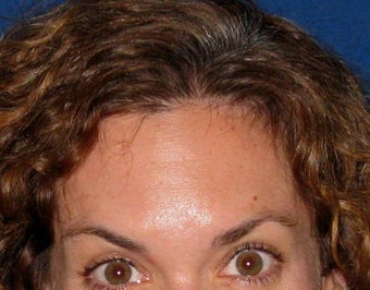 Botox after 206154