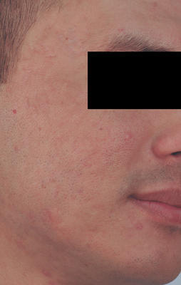 Laser Resurfacing for Acne Scars after 82980