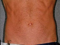 Liposonix after 582688