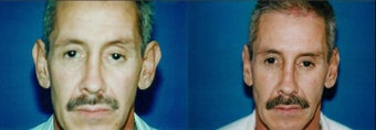 Otoplasty before 633525