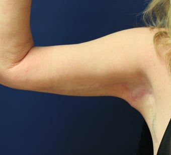 Arm lift (brachioplasty) after 548317