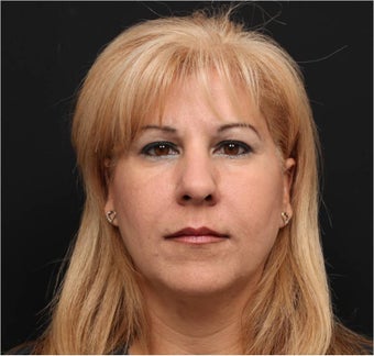 Restylane & Juvederm after 444312