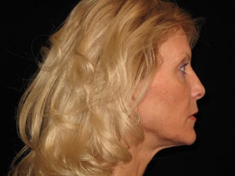 Botox and Restylane 323691