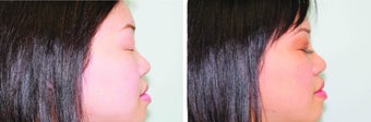 Double Eyelid Surgery Suture 548933