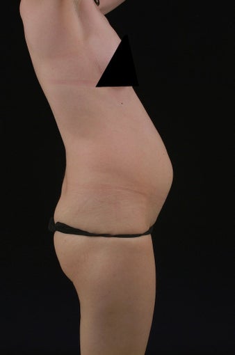 Liposuction before 513558