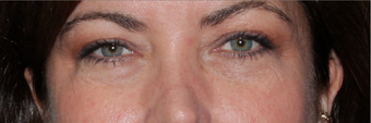 Restylane before 590808