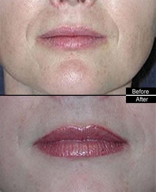 Lip Fillers before 91566
