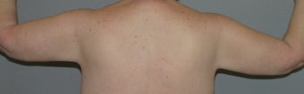 Arm-lift, Brachioplasty 564065