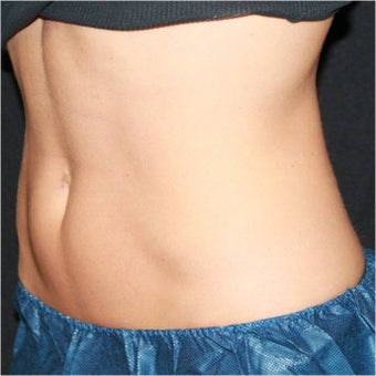CoolSculpting after 420663