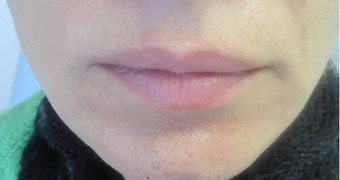 Radiesse Injection after 387859