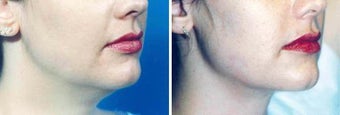Chin Liposuction before 640702
