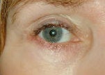 Eyelid skin cancer reconstruction after 84502