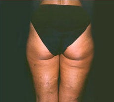 Smartlipo before 401658