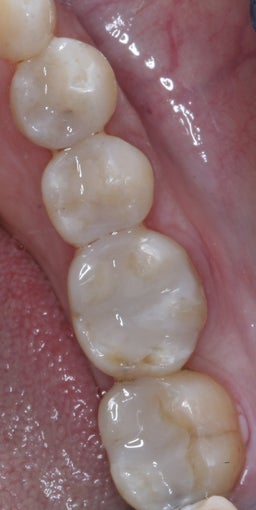 Mercury Silver filling replacement after 372798