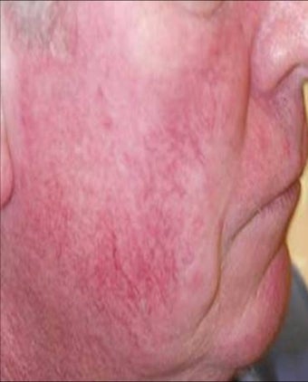 Vein treatment before 135897