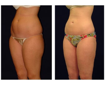 Liposuction before 286715