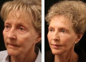 Profractional before 601408