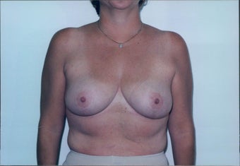 Breast Reduction after 218953