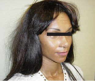 Rhinoplasty after 172974