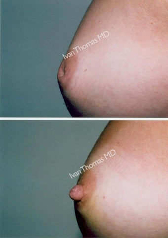 Nipple Surgery before 243242