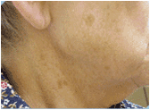 photofacial before 267552