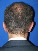 Ear Surgery (Otoplasty) 357660