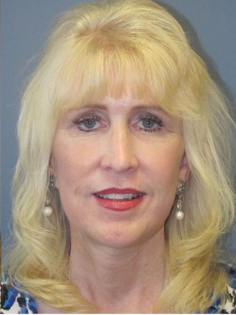 Neck Lift, Platysmaplasty after 634754