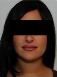 Evolence Injection Lips after 123634