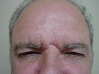 Botox 531096
