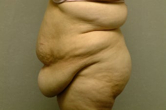 Abdominoplasty-Tummy Tuck with Liposuction before 607275