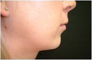 Chin Augmentation before 205405