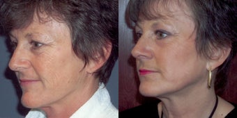 CO2 laser skin resurfacing before 78398