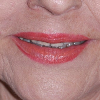 Laser Resurfacing after 588404