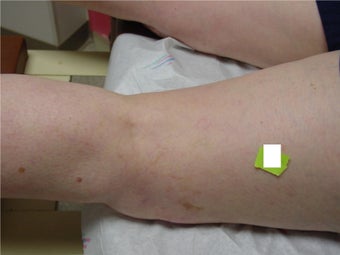 Sclerotherapy after 297055