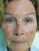Skin Resurfacing Using Plasma Rejuvenation with Portrait before 196054