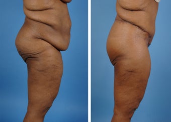 Lower Body Lift with Laser Liposuction to the Hips and Thighs 335995