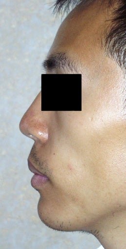 Chin Augmentation after 365454