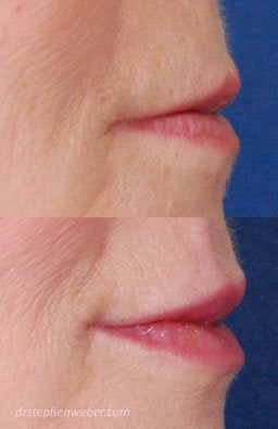 Restylane Lip Injection before 222100