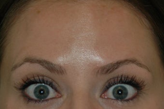 Botox injected in between the eyebrows and into the forehead 577107